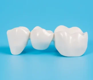 Dental Bridges