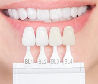 Dental Veneers