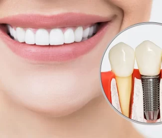 Are-Dental-Implants-Painful-Step-by-Step-Process-Explained